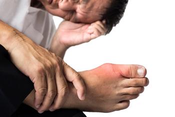 Patients With Gout at Increased Risk for Lower Extremity Amputation