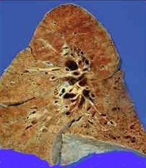 Lung Disease in Scleroderma, Part II: Vital Basics About PAH ...