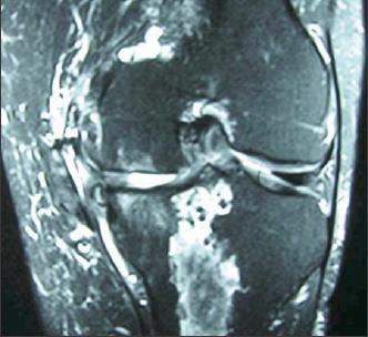 Mri Images Of Problem Knee