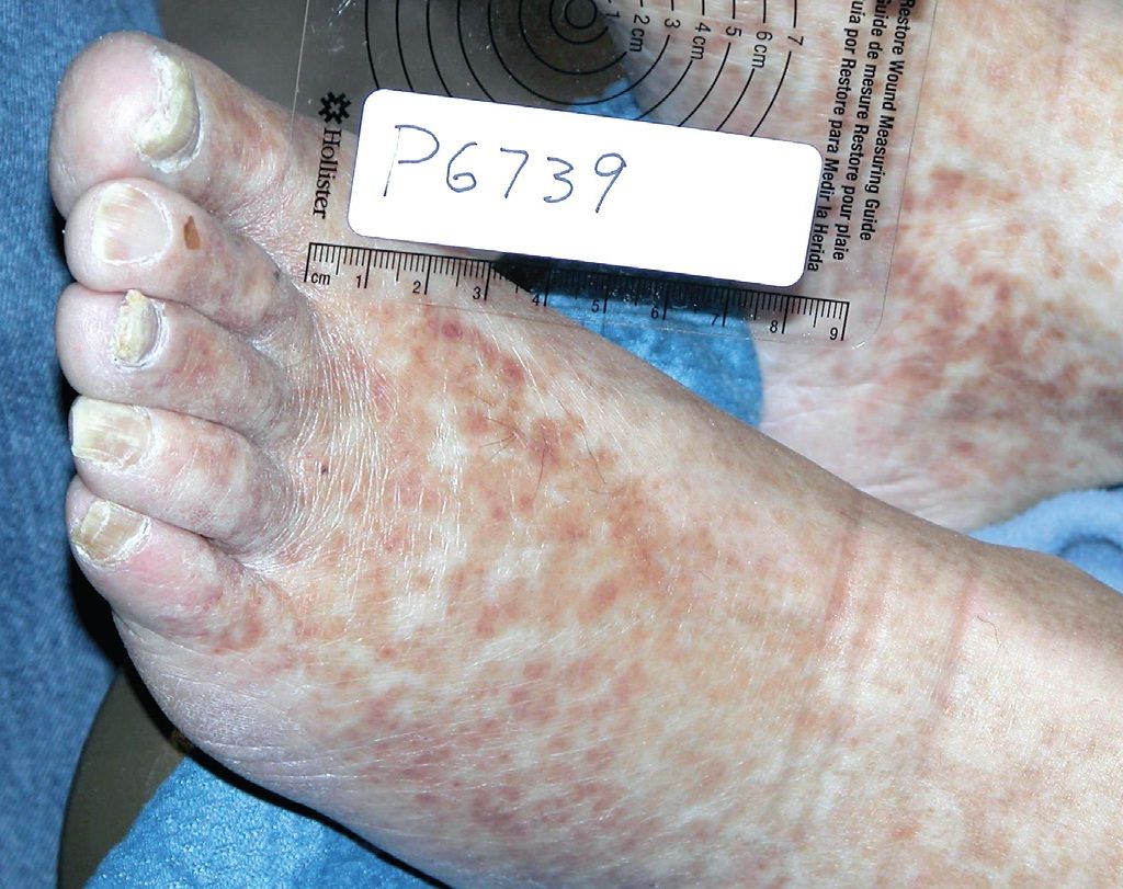Ulcers And Gangrene In The Hands And Feet Of A 56 Year Old Man Ulcers And Gangrene In The Hands And Feet Of A 56 Year Old Man