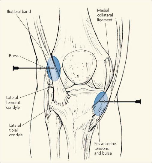 pes anserine tendon