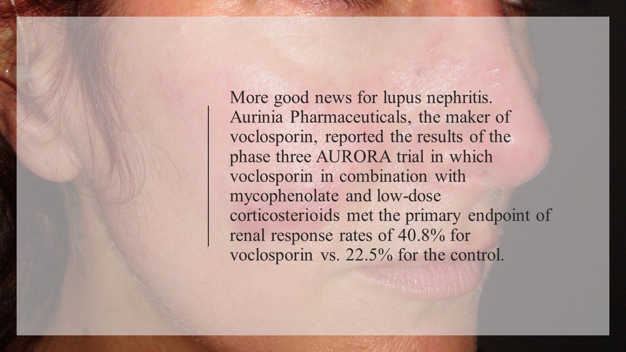 2019's Top Treatment Advances in Lupus