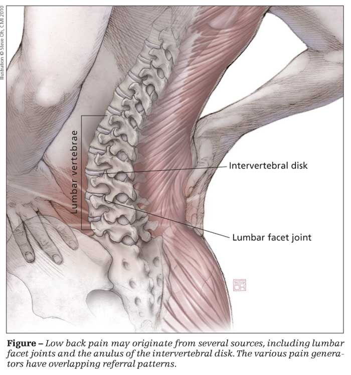 Pin on Lumbar spinal stenosis