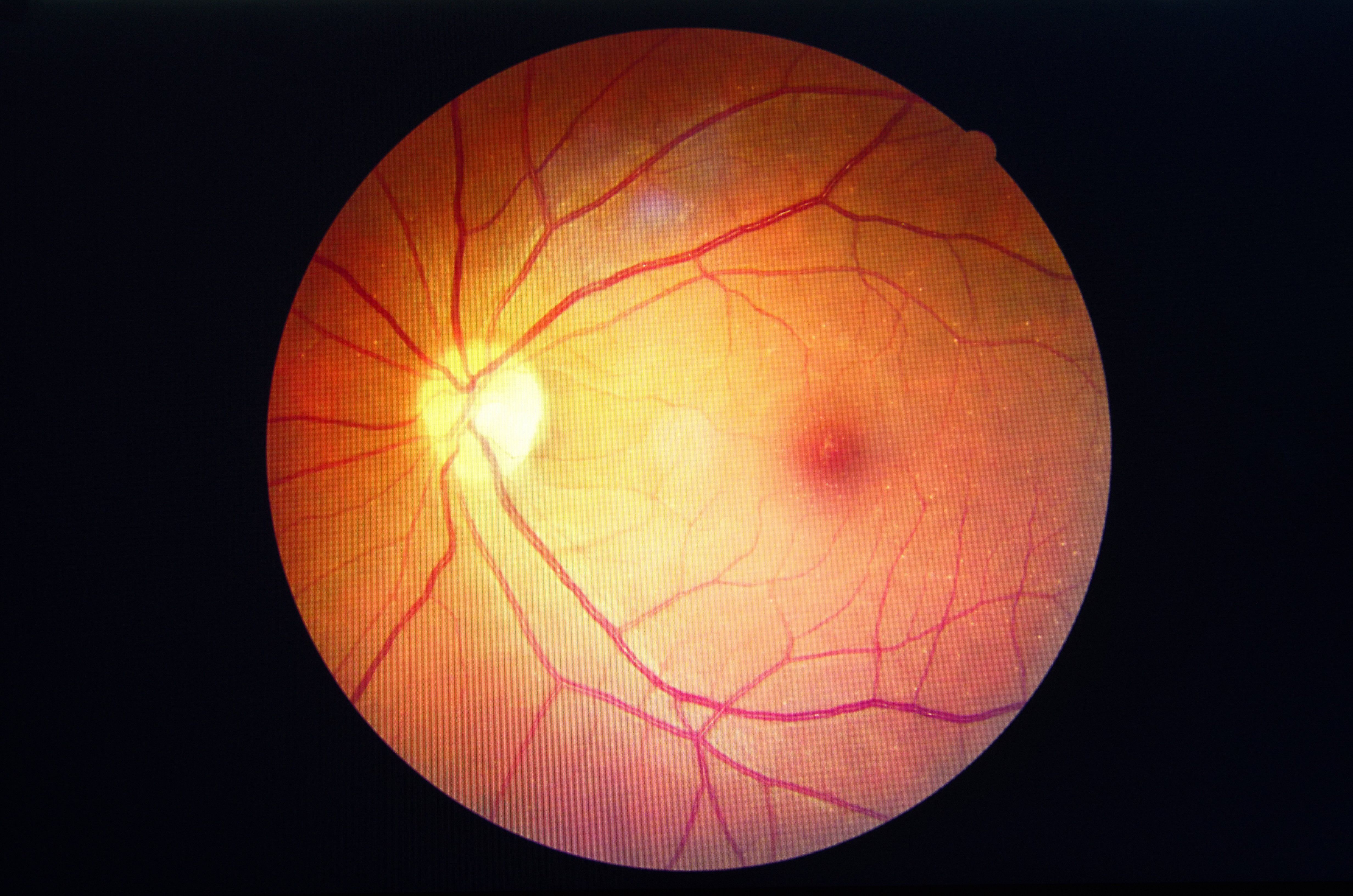 Retinopathy Risk in Lupus Increases With Longer Hydroxychloroquine Use