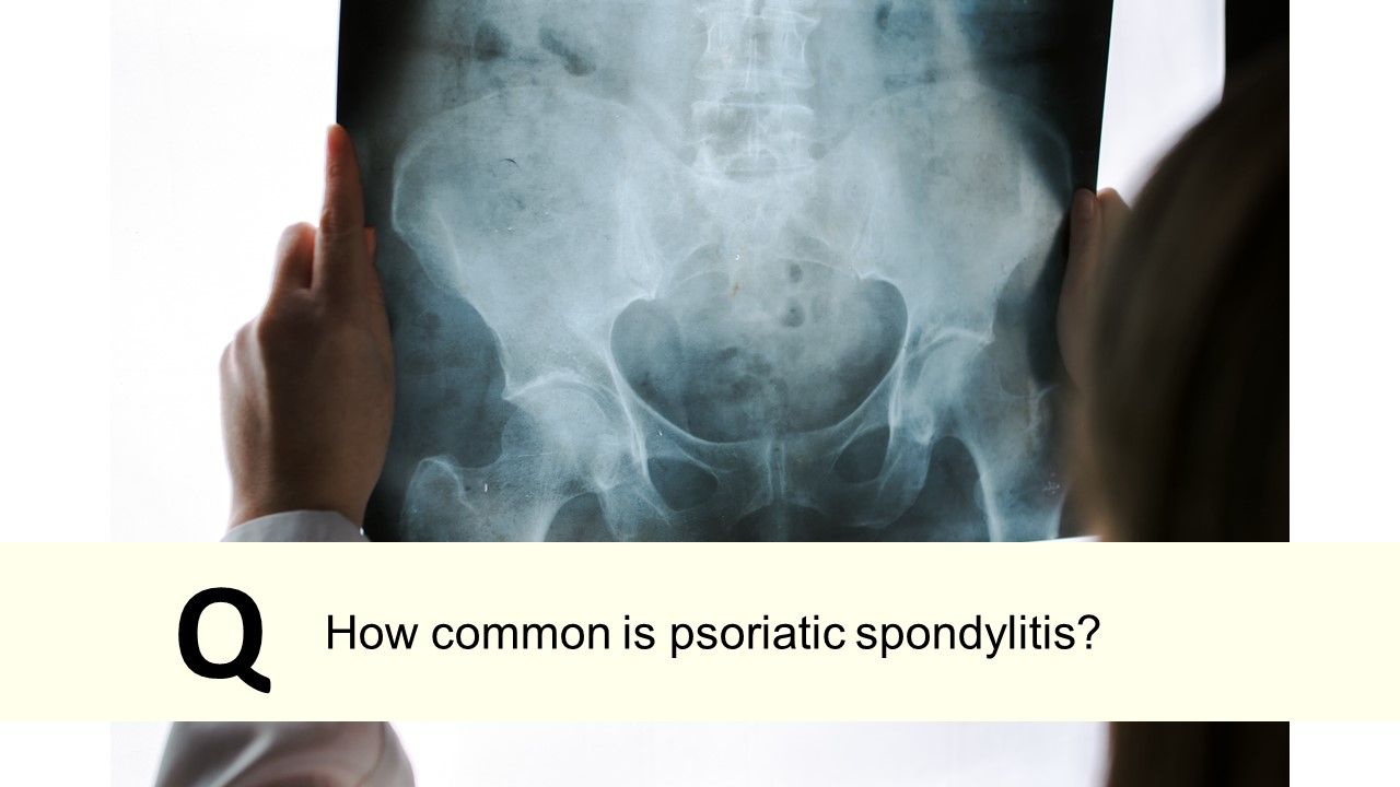 How common is psoriatic spondylitis?
