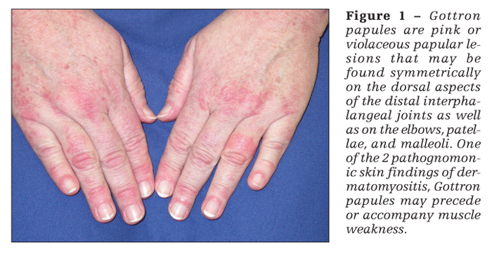 Diagnosis And Management Of Inflammatory Muscle Disease