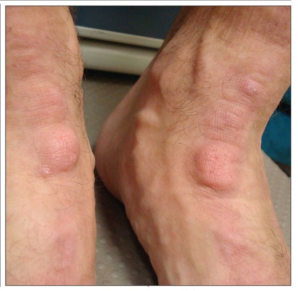 a-soldier-with-lumps-on-his-feet-rheumatology-network