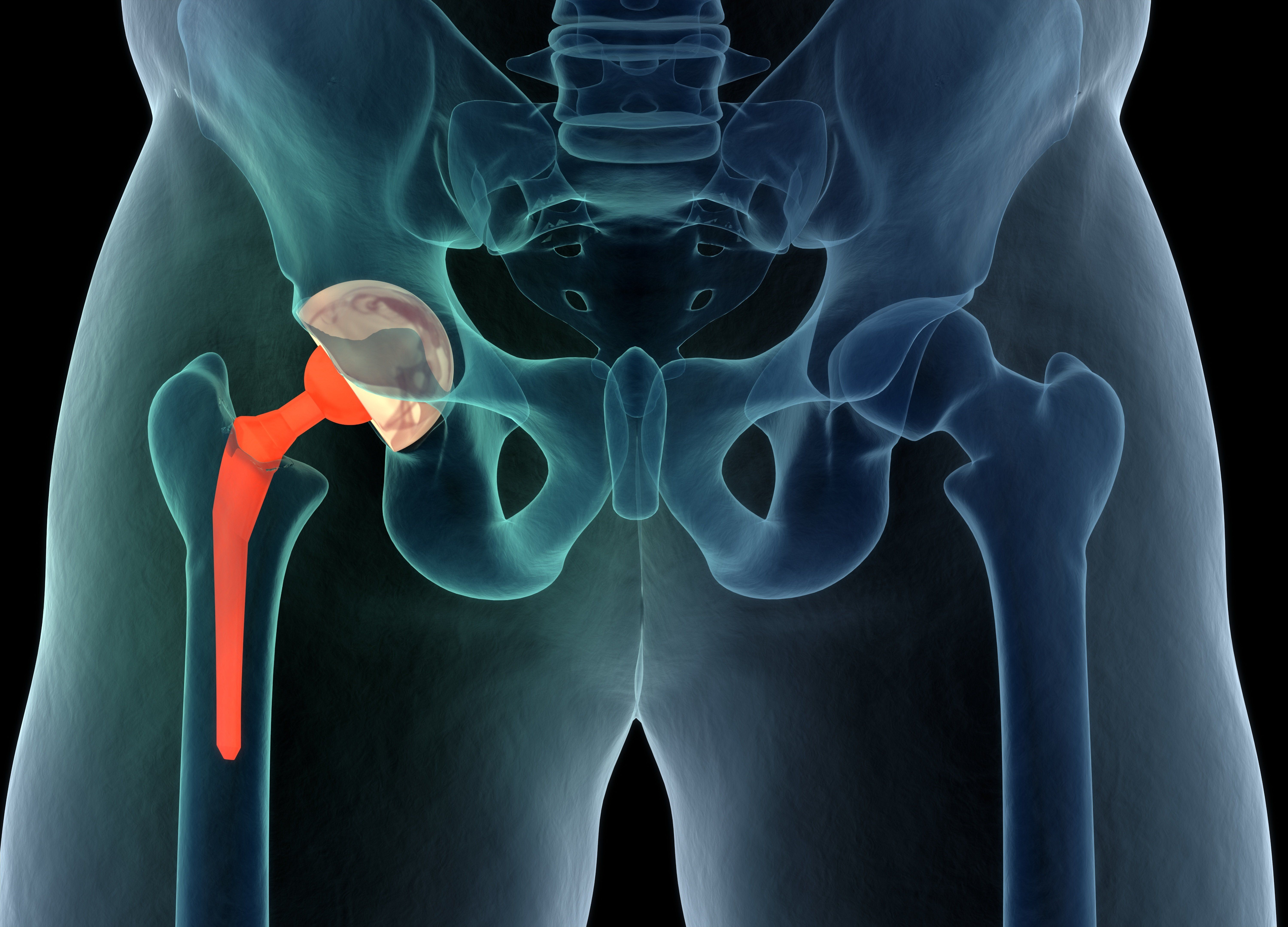 How Long Does A Hip Replacement Last
