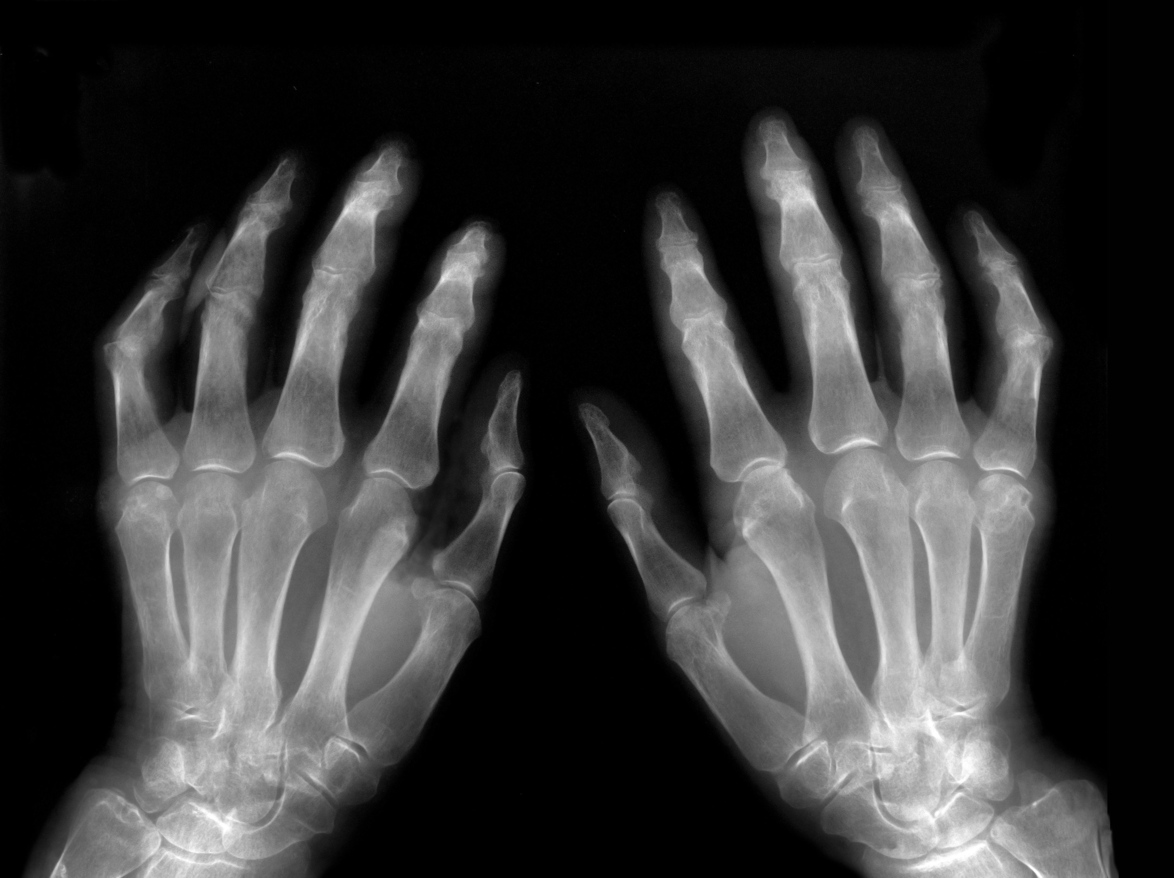 rheumatoid arthritis radiology findings)