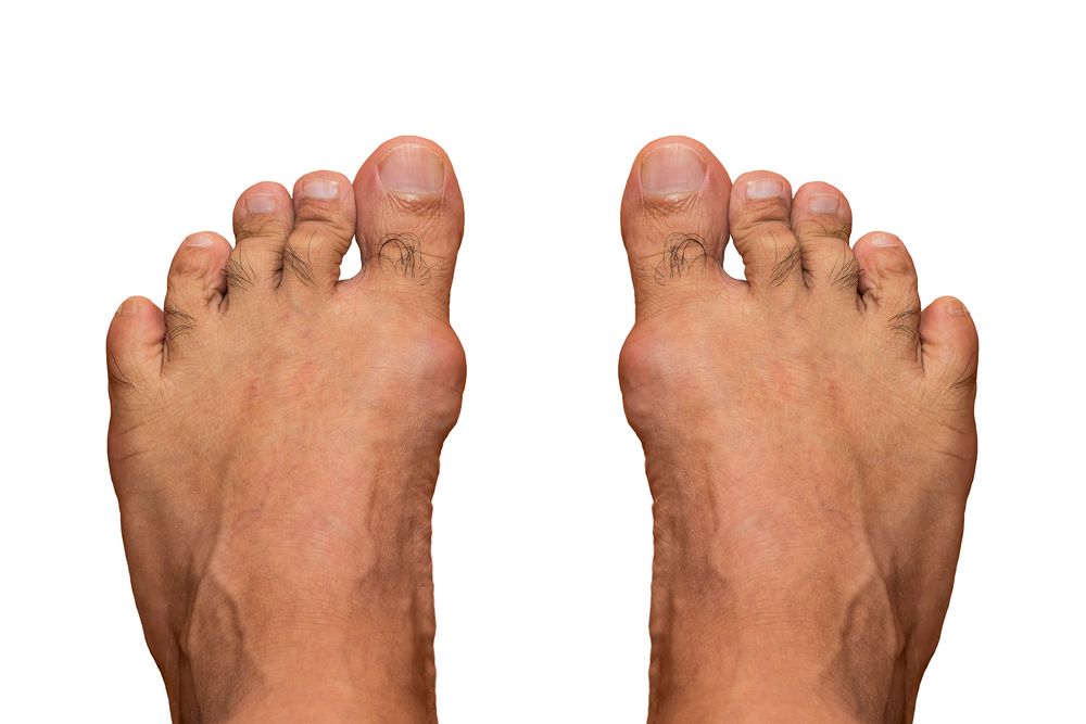 (Gout inflammation of big toe joint. ©ShutterRyder/Shutterstock.com)