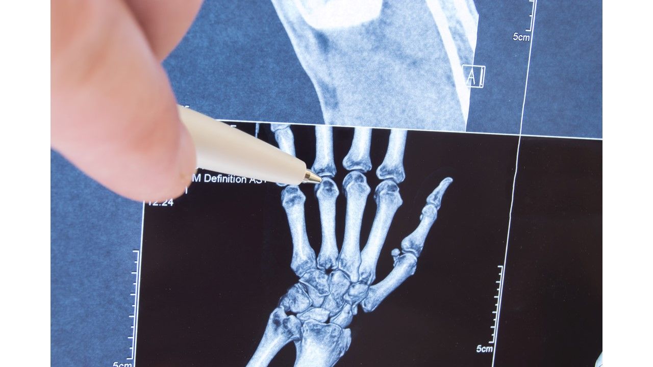 Clinical Quiz Rheumatoid Arthritis Flares Rheumatology Network