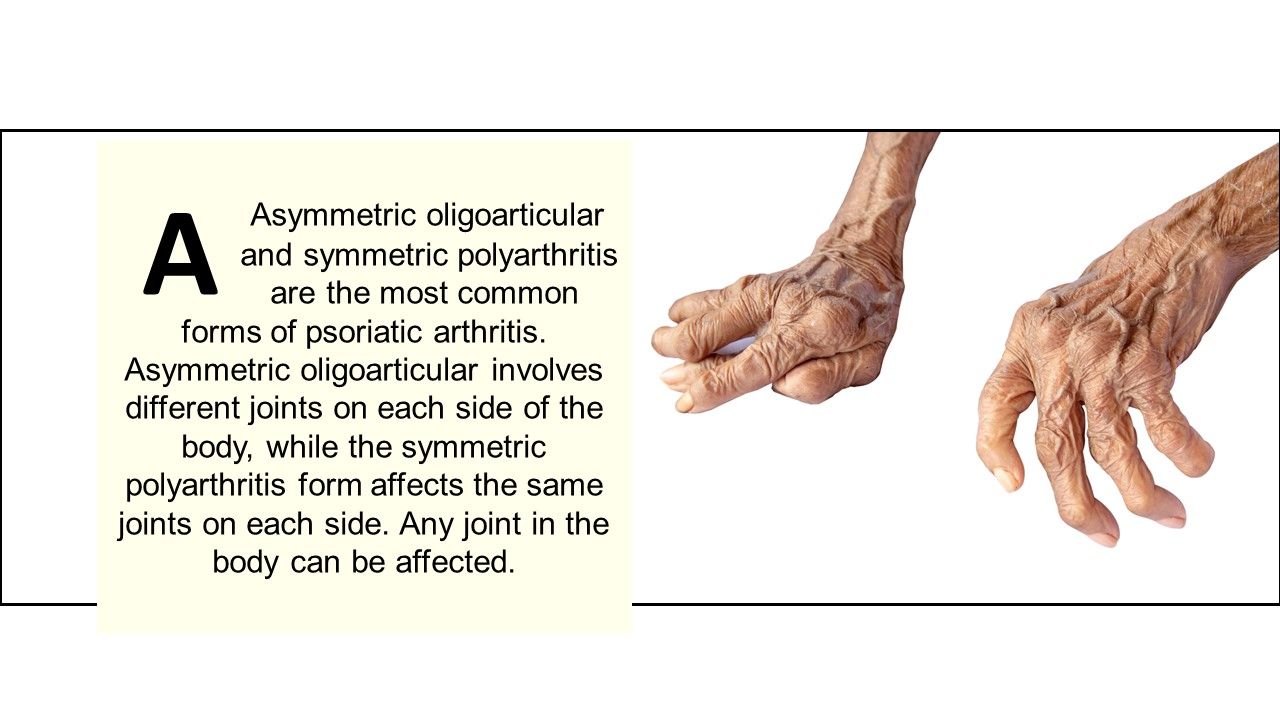 What are the two most common forms of psoriatic arthritis?