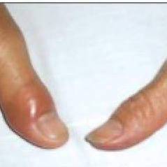 Woman with Suddenly Painful, Swollen Thumb | Rheumatology Network