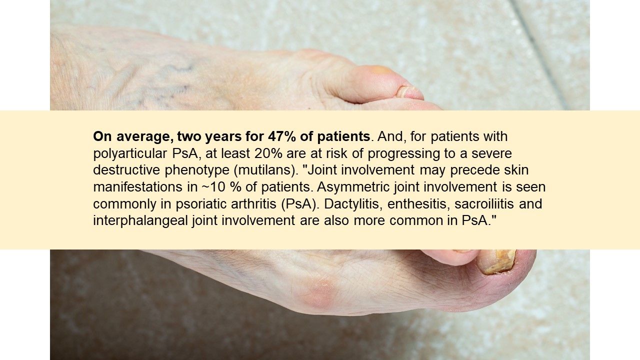Psoriatic Arthritis Quiz: Monotherapy, Complimentary Medicine and Joint Destruct