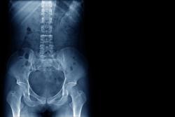 Upadacitinib Receives Positive CHMP Opinion for Treatment of Non-Radiographic Axial Spondyloarthritis 