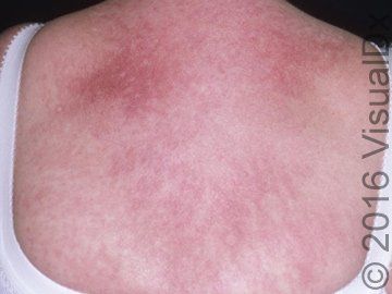 clinical quiz rash on chest muscle weakness