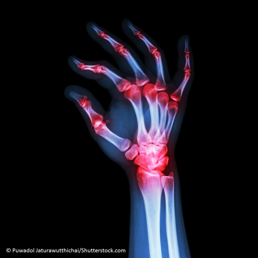 Filgotinib With Methotrexate for Rheumatoid Arthritis | Rheumatology ...