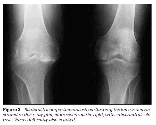 7 Osteoarthritis Imaging Rheumatology