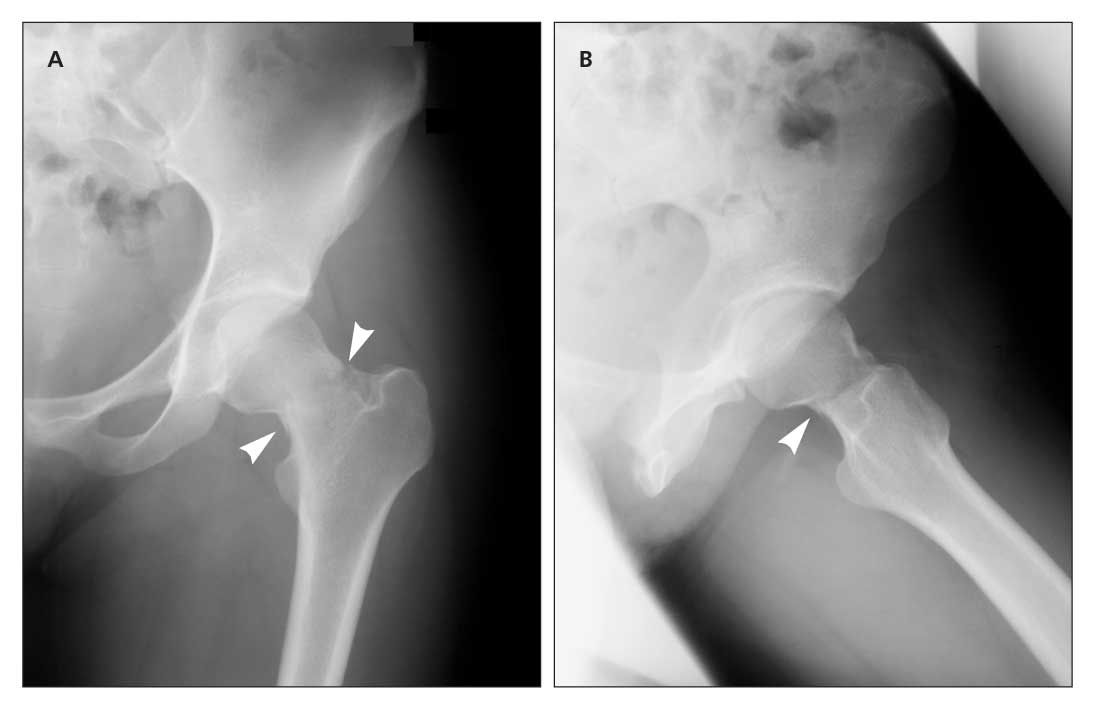 A Completed Stress Fracture In A Marathon Runner Case Report A Completed Stress Fracture In A Marathon Runner Case Report