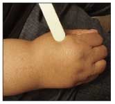 Evaluating Edema Of The Hands