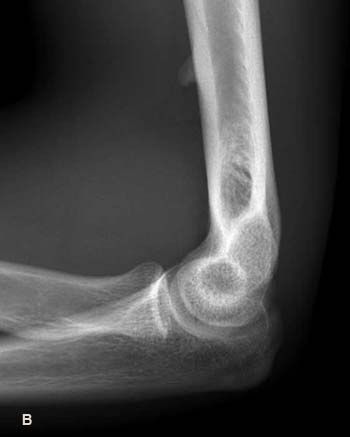 Boy With a Bump on His Elbow | Rheumatology Network