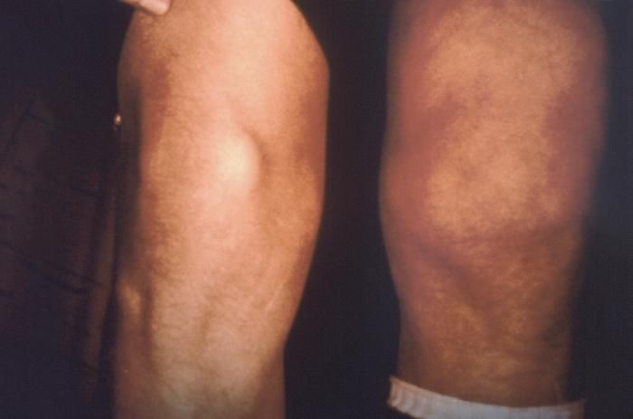 Autoimmune Joint Disease After A Lyme Disease Infection Autoimmune Joint Disease After A Lyme Disease Infection