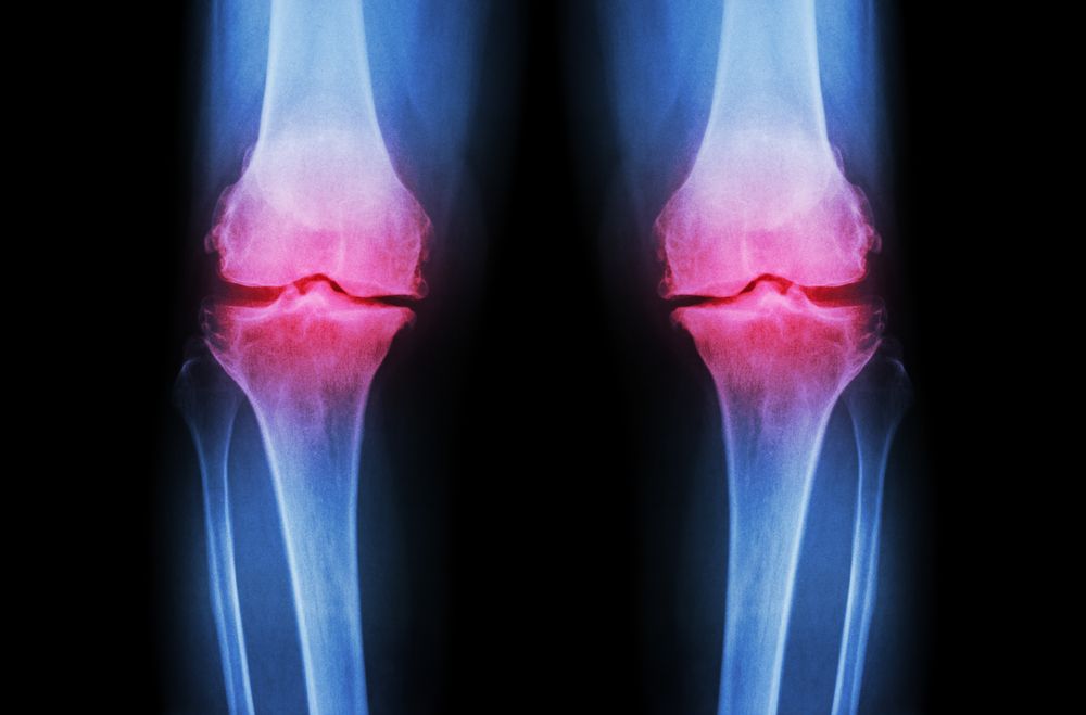 Hyaluronic Acid for Knee Osteoarthritis Hyaluronic Acid for Knee Osteoarthritis