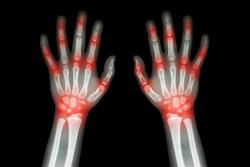 Rheumatoid Arthritis Year in Review: 2022