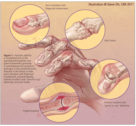 Psoriatic Arthritis A Disease In Full