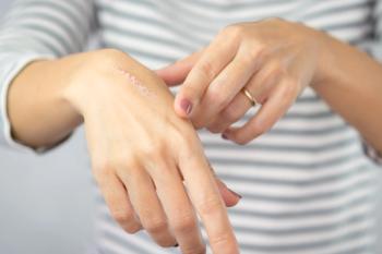 Close up of cooking oil burn scar on a woman's hands. The skin damage in first-degree on outer layer skin. | Image Credit: © myboys.me - stock.adobe.com