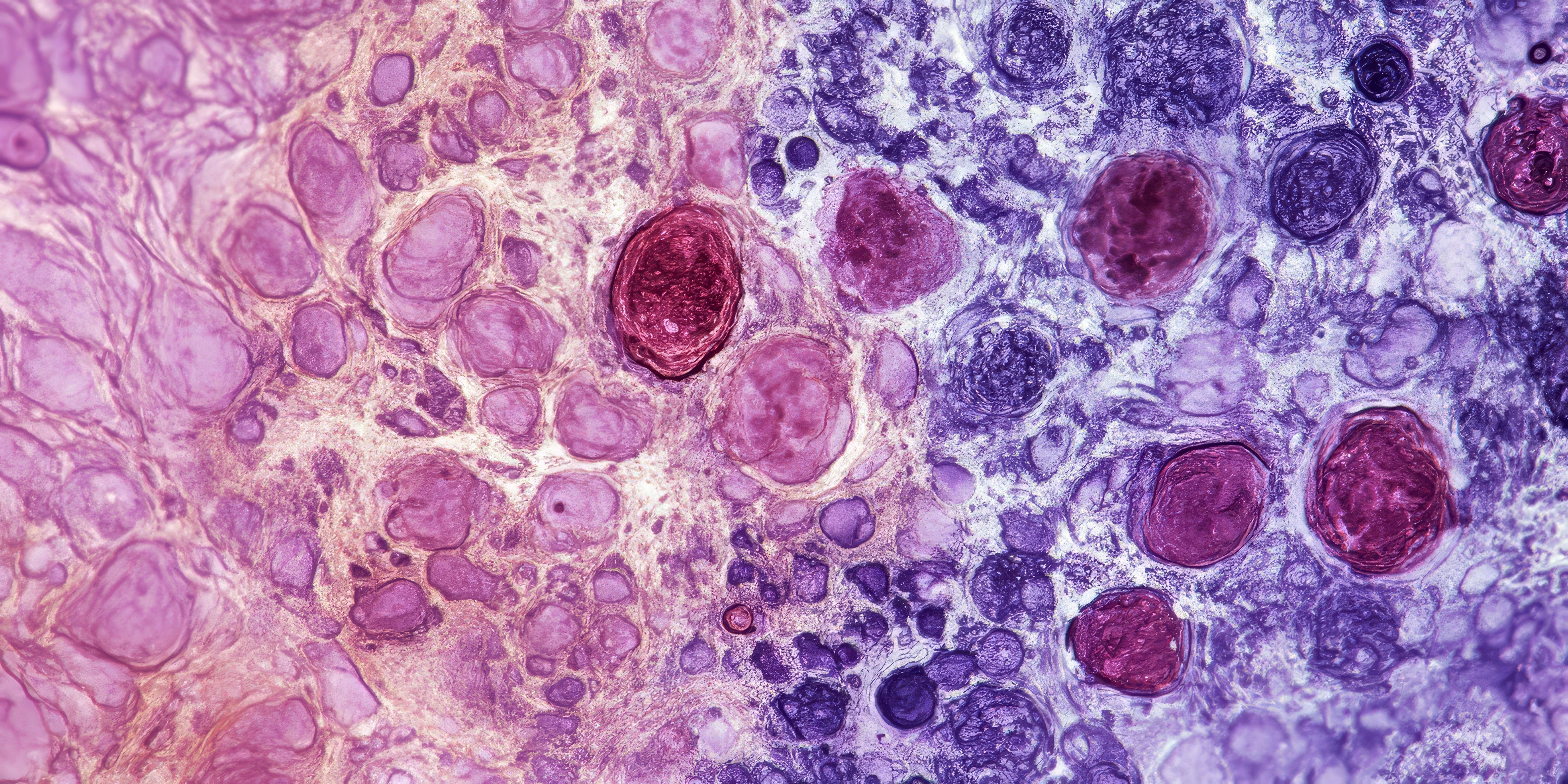 Light micrograph depicting a liver needle biopsy in haemochromatosis. This liver biopsy reveals hepatocytes with distinct brown iron deposits and highlights a fibrotic portal tract at the top. Generated with AI. | Image Credit: © Levan - stock.adobe.com