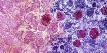 Light micrograph depicting a liver needle biopsy in haemochromatosis. This liver biopsy reveals hepatocytes with distinct brown iron deposits and highlights a fibrotic portal tract at the top. Generated with AI. | Image Credit: © Levan - stock.adobe.com