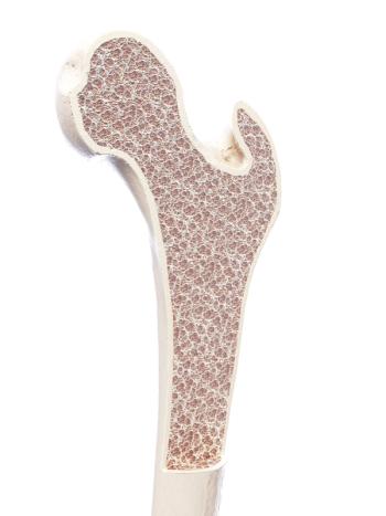 3d rendered, medically accurate illustration of osteoporosis | Image Credit: © Sebastian Kaulitzki - stock.adobe.com