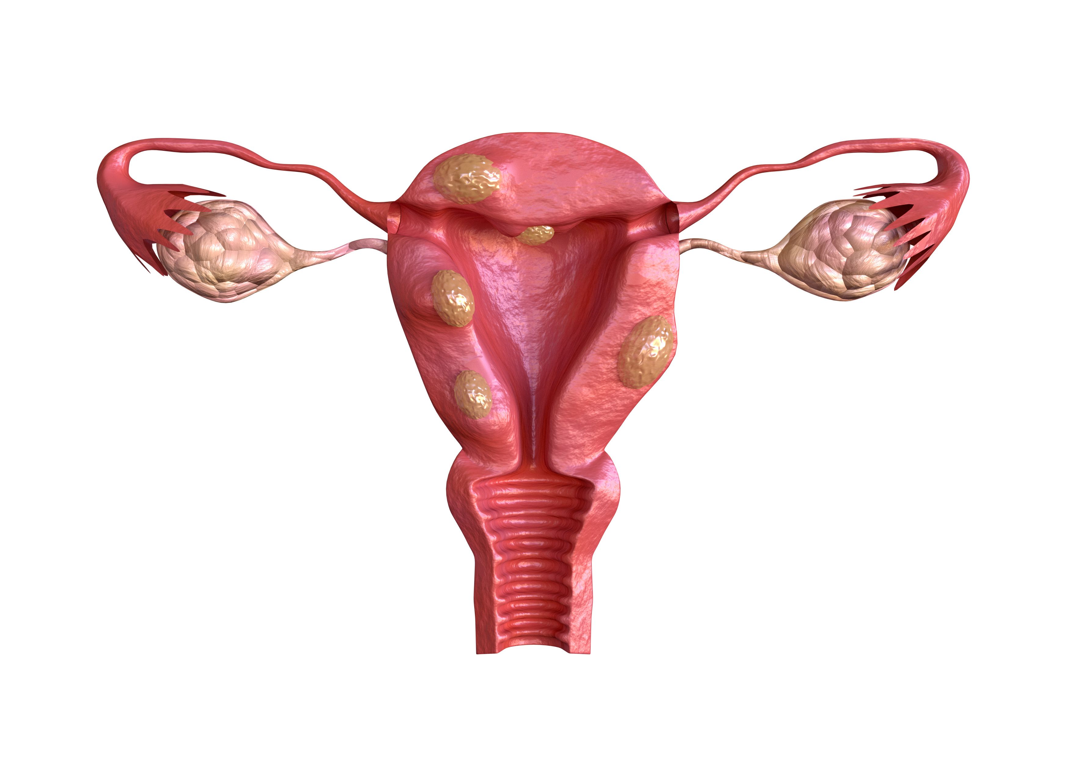 Uterine fibroid are benign solid tumors formed by muscle tissue. Its size can vary greatly and some cause large abdomen increase | Image Credit: © AGPhotography - stock.adobe.com