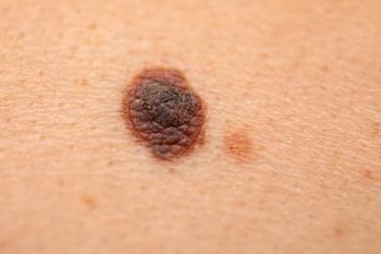 Dangerous nevus on skin (melanoma) | Image Credit: © Ocskay Mark - stock.adobe.com.