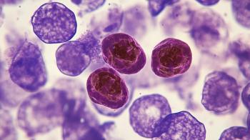 Acute lymphoblastic leukemia ALL is a type of blood cancer that occurs when the bone marrow produces too many abnormal lymphocytes, a type of white blood cell. Generated with AI. | Image Credit: © Thipphaphone - stock.adobe.com