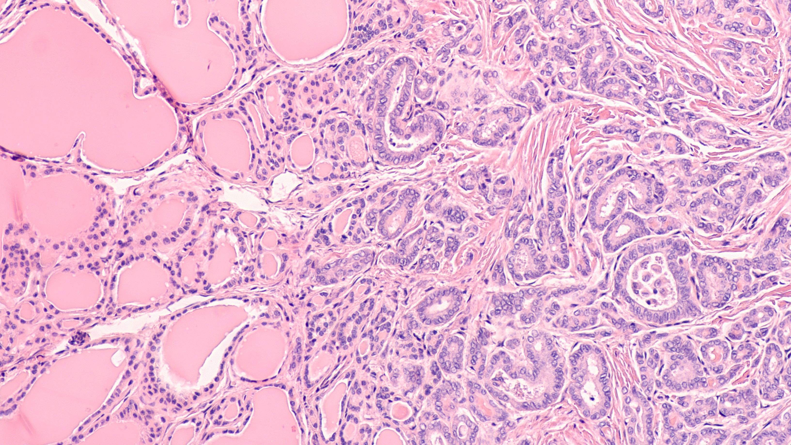 papillary thyroid cancer psammoma bodies