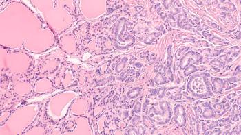 Thyroid gland cancer awareness: Microscopic image of papillary thyroid carcinoma, follicular variant (left), with invasion into benign follicles or normal thyroid tissue (right). | Image Credit: © David A Litman - stock.adobe.com