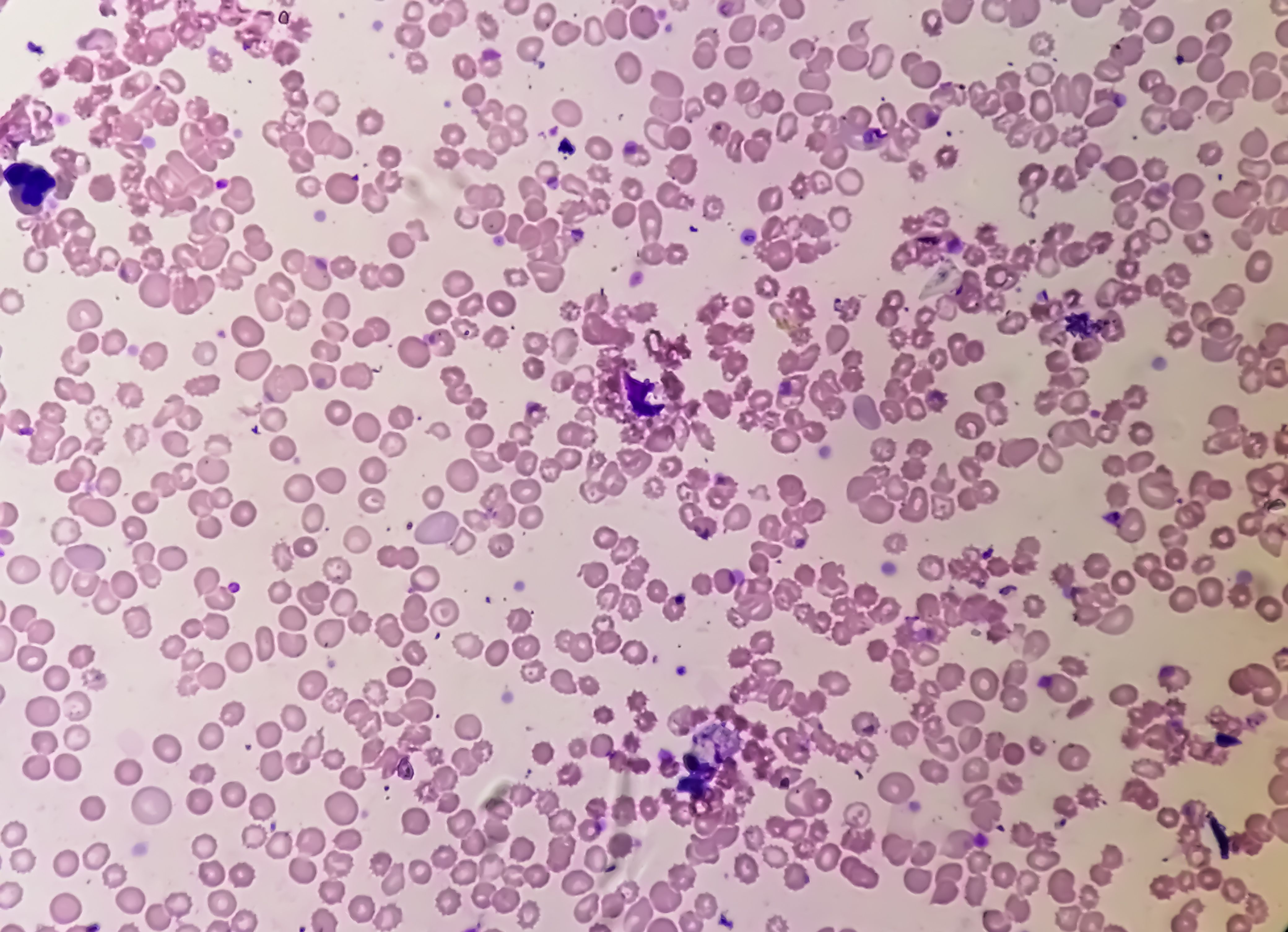 Microscopic view of hematological slide showing Pancytopenia. A condition in which there is a lower number of RBC, WBC and platelets in the blood. | Image Credit: © Saiful52 - stock.adobe.com.