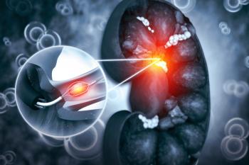 Extended Endoscopic removal of stones from the kidneys and ureter. 3d illustration | Image Credit: © Crystal light - stock.adobe.com