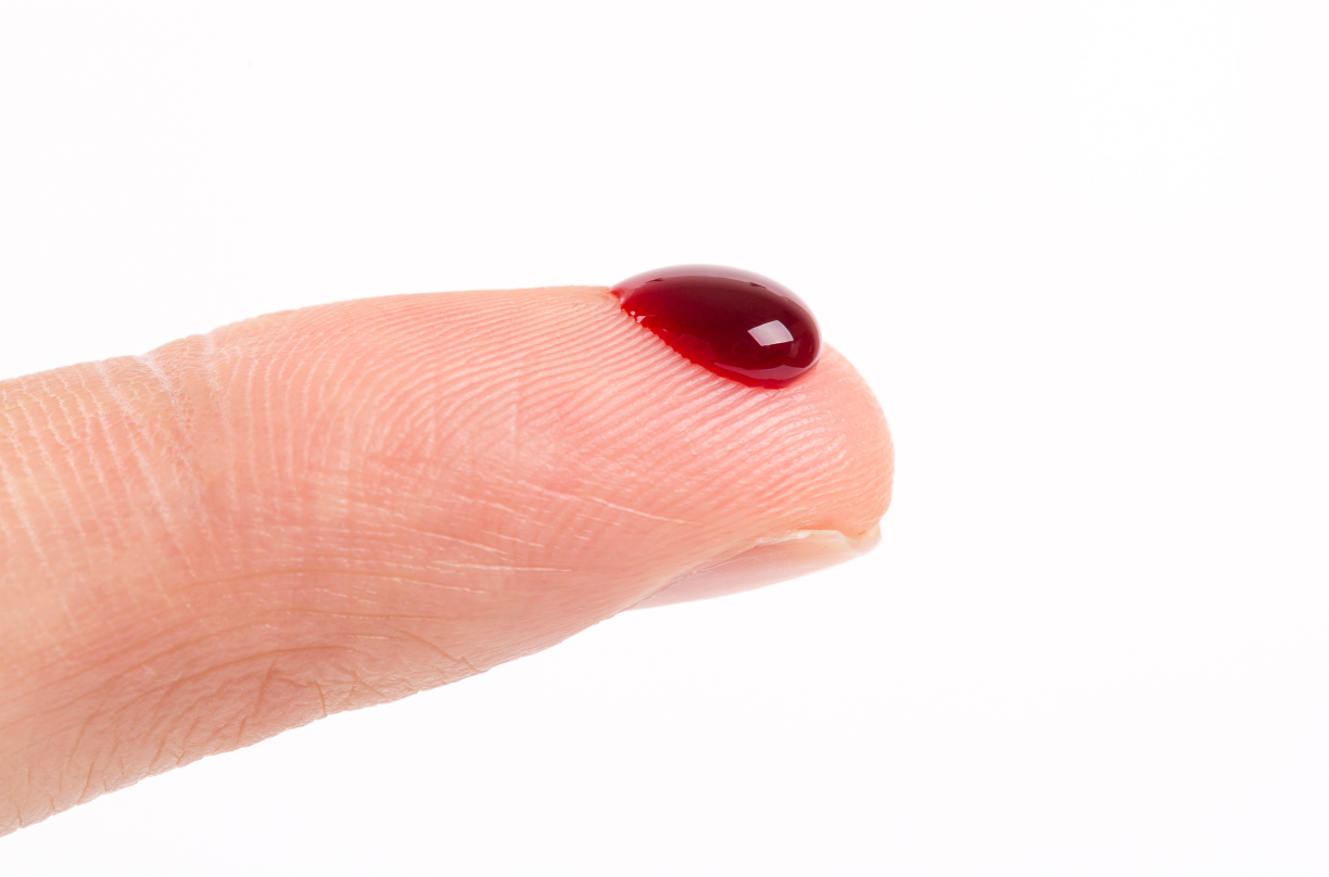 Fingerstick bead of blood for traditional invasive glucose testing © ddukang-chronicles-stock.adobe.com  