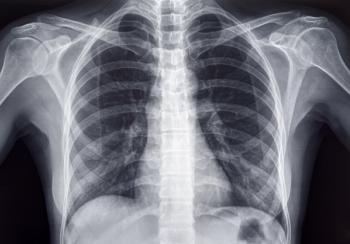Chest x-ray of an adult female human | Image Credit: © PhotoEdit - stock.adobe.com.