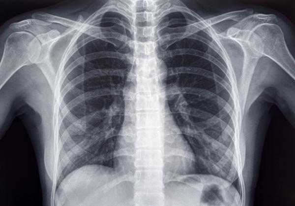 Chest x-ray of an adult female human | Image Credit: © PhotoEdit - stock.adobe.com.