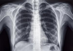 Chest x-ray of an adult female human | Image Credit: © PhotoEdit - stock.adobe.com.