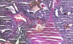 Lenvatinib Meets Primary Endpoint in Phase III Differentiated Thyroid Cancer Study