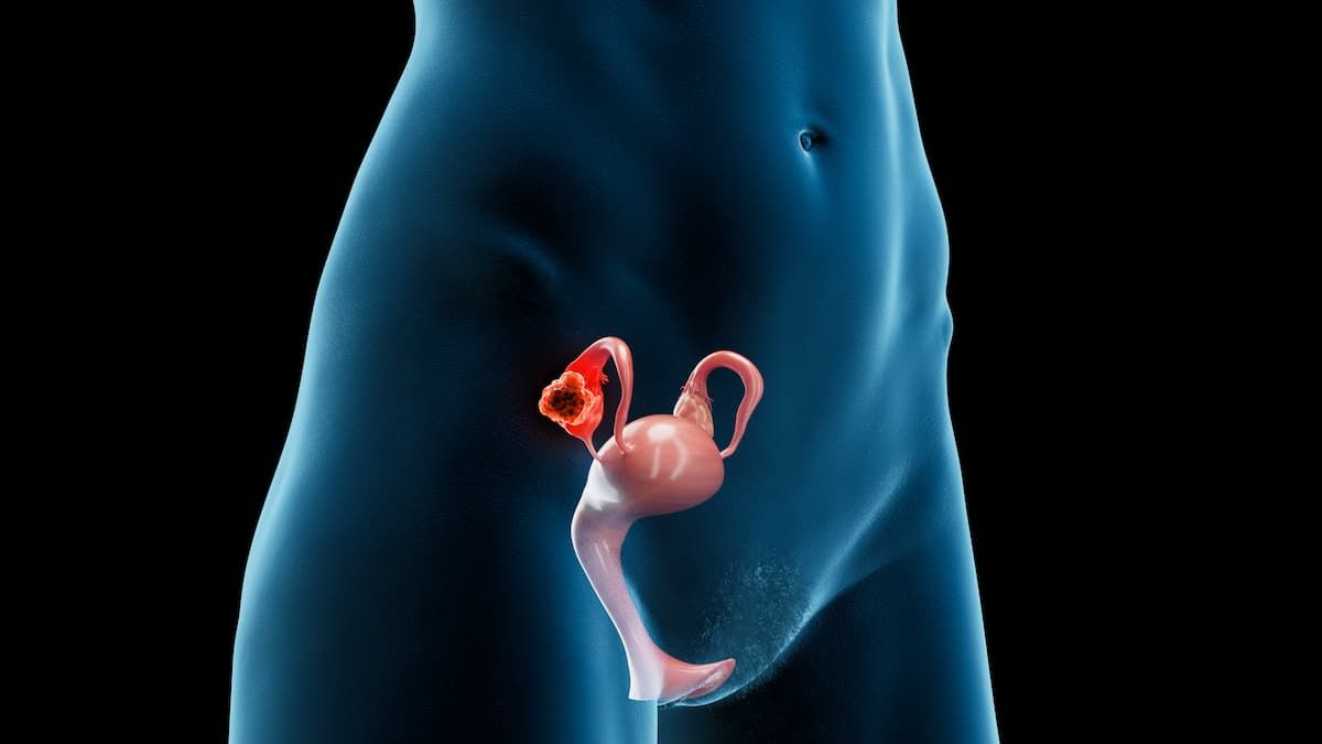 Sofetabart Mipitecan Elicits Responses Across FRα Levels in Ovarian Cancer