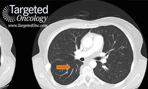 Tropomyosin-Related Kinases (TRK) Making Headway in Head and Neck Cancer