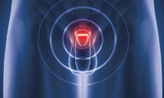 Metastatic Prostate Cancer: Case 2