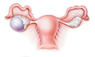 Gynecologic Cancers: Case 1