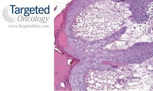 Case Shows Dramatic Antitumor Effects With Immunotherapy in Melanoma